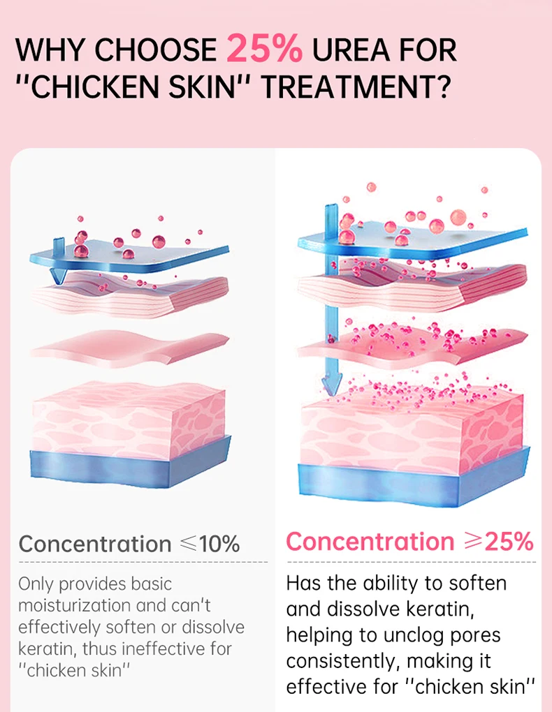 Body Cream Chicken Skin Removal Treatment Keratosis Pilaris Lotion Rough Bumpy Pore Spots Care Moisturizer Whitening Creams 60g Body Cream Chicken Skin Removal Treatment Keratosis Pilaris Lotion Rough Bumpy Pore Spots Care Moisturizer Whitening Creams 60g