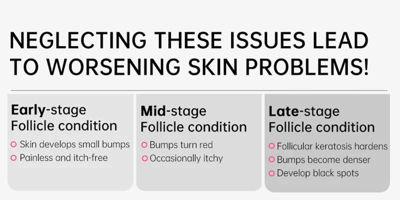 Body Cream Chicken Skin Removal Treatment Keratosis Pilaris Lotion Rough Bumpy Pore Spots Care Moisturizer Whitening Creams 60g Body Cream Chicken Skin Removal Treatment Keratosis Pilaris Lotion Rough Bumpy Pore Spots Care Moisturizer Whitening Creams 60g